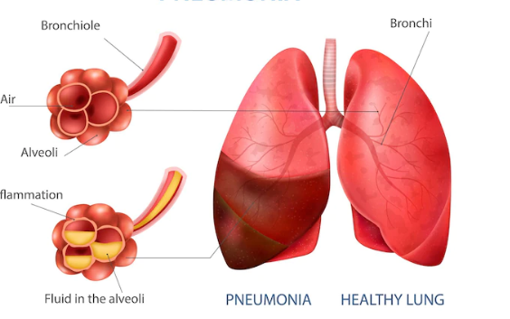 Best Respiratory Medicine Hospital in Patna